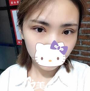 在韓國美line整形醫(yī)院做雙眼皮一周 在韓國美line整形醫(yī)院做雙眼皮一周