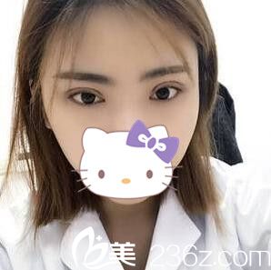 李重根做的雙眼皮20天效果 李重根做的雙眼皮20天效果