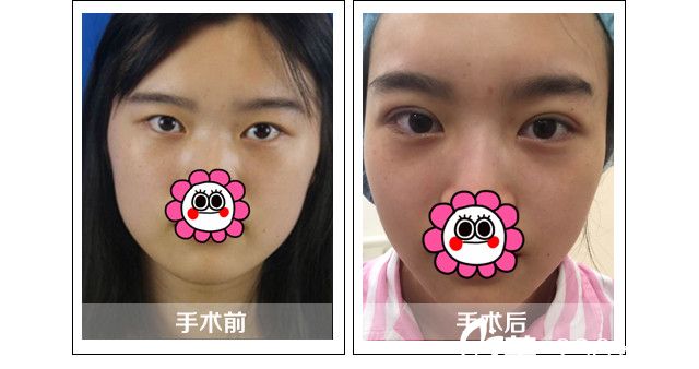 張凡醫(yī)生雙眼皮案例 張凡醫(yī)生雙眼皮案例