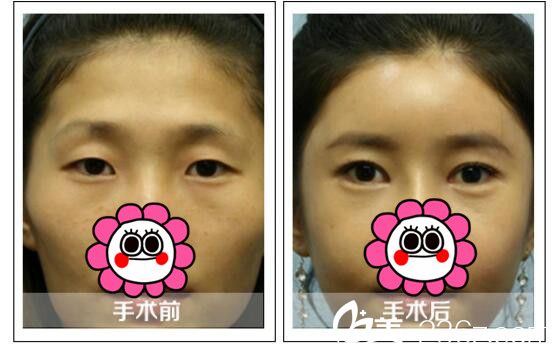 張凡雙眼皮案例 張凡雙眼皮案例