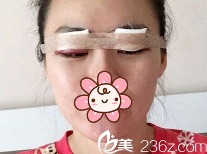 剛做完埋線法雙眼皮 剛做完埋線法雙眼皮