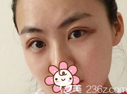 冰敷后雙眼皮適當(dāng)消腫 冰敷后雙眼皮適當(dāng)消腫