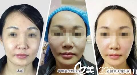 全面年輕化術(shù)后效果對(duì)比