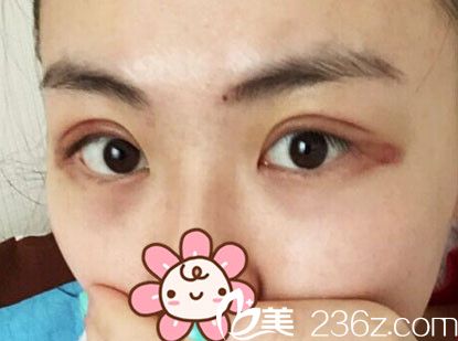 術(shù)后四天雙眼皮手術(shù)恢復(fù)中 術(shù)后四天雙眼皮手術(shù)恢復(fù)中