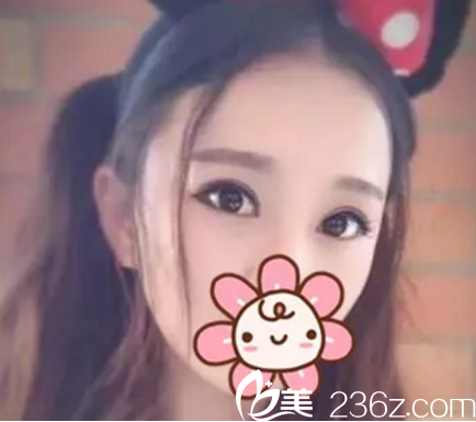 想知道在南寧芯玥做雙眼皮好嗎？分享我在南寧芯玥術(shù)后2月效果