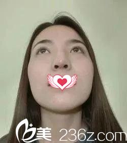 鼻綜合7天拆線后的樣子 鼻綜合7天拆線后的樣子