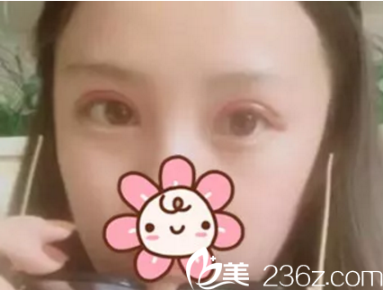 南寧美麗星做雙眼皮術(shù)后15天