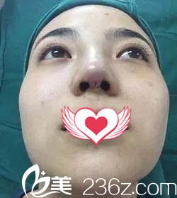 剛做完鼻綜合整形的鼻子有點(diǎn)腫 剛做完鼻綜合整形的鼻子有點(diǎn)腫