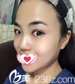 術(shù)前鼻子塌平 術(shù)前鼻子塌平