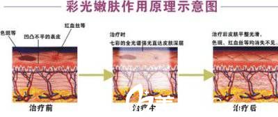 光子嫩膚原理 光子嫩膚原理