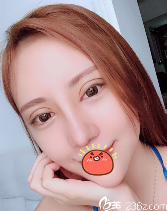 在寧波童顏做雙眼皮和隆鼻20天后 在寧波童顏做雙眼皮和隆鼻20天后