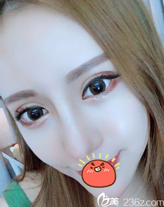 找寧波童顏?zhàn)隽穗p眼皮和隆鼻手術(shù),現(xiàn)在恢復(fù)2個(gè)月疤痕不明顯效果自然了