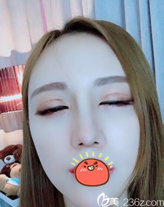 做完雙眼皮手術2個月疤痕情況 做完雙眼皮手術2個月疤痕情況