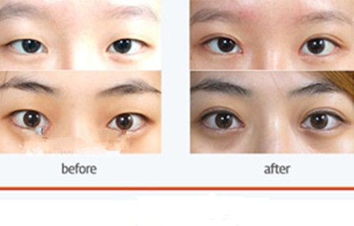  韓國朱麗葉整形醫(yī)院雙眼皮手術(shù)案例