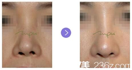 歪鼻、鼻尖整形前后對(duì)比