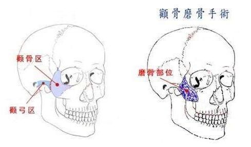 韓國(guó)江南stardom整形外科陳尚佑顴骨整形 韓國(guó)江南stardom整形外科陳尚佑顴骨整形