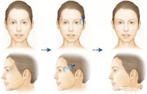 顴骨整形手術(shù)過(guò)程 顴骨整形手術(shù)過(guò)程