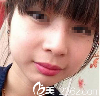 第二次皮秒激光祛斑術(shù)后恢復(fù)