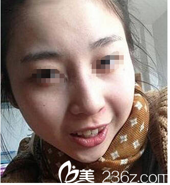 打聽到無(wú)錫同舟引進(jìn)了蜂巢皮秒祛斑神器 體驗(yàn)了三個(gè)療程后告別了20多年的雀斑