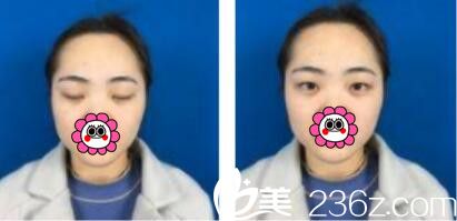 韓國江南stardom整形外科陳尚佑雙眼皮真人案例術(shù)前照 韓國江南stardom整形外科陳尚佑雙眼皮真人案例術(shù)前照