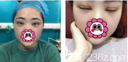 韓國江南stardom整形外科陳尚佑雙眼皮真人案例術(shù)后第三天 韓國江南stardom整形外科陳尚佑雙眼皮真人案例術(shù)后第三天