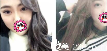 韓國江南stardom整形外科陳尚佑雙眼皮真術(shù)后第七天人案例 韓國江南stardom整形外科陳尚佑雙眼皮真術(shù)后第七天人案例