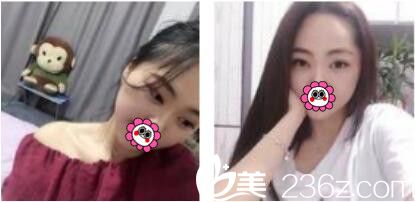 韓國江南stardom整形外科陳尚佑雙眼皮真人案例術(shù)后一個月 韓國江南stardom整形外科陳尚佑雙眼皮真人案例術(shù)后一個月