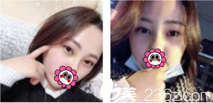 想知道韓國(guó)江南stardom做了雙眼皮好不好，看我三個(gè)月前找陳尚佑做的韓式雙眼皮術(shù)后效果圖