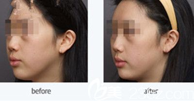 脂肪移植案例 脂肪移植案例
