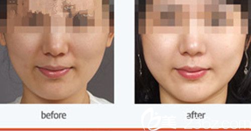 面頰 貴族填充針案例 面頰 貴族填充針案例