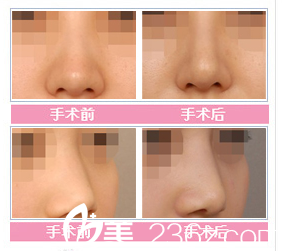 張家港康麗整形醫(yī)院隆鼻對(duì)比案例 張家港康麗整形醫(yī)院隆鼻對(duì)比案例