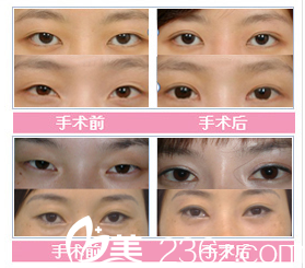 張家港康麗整形醫(yī)院眼部整形對(duì)比案例 張家港康麗整形醫(yī)院眼部整形對(duì)比案例