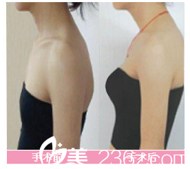 張家港康麗整形醫(yī)院胸部整形對(duì)比案例 張家港康麗整形醫(yī)院胸部整形對(duì)比案例
