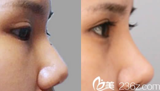 韓國(guó)然美之整形隆鼻效果圖 韓國(guó)然美之整形隆鼻效果圖