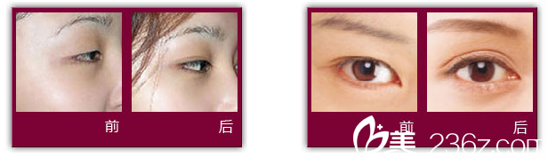 張建軍主任雙眼皮案例 張建軍主任雙眼皮案例