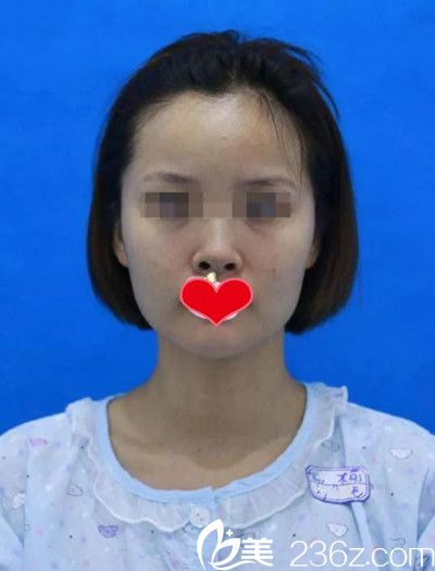 手術(shù)前 手術(shù)前