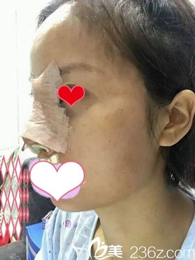 鼻綜合手術(shù)后1天 鼻綜合手術(shù)后1天