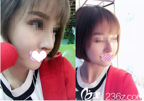 劉志強院長給我做鼻綜合手術(shù)35天了 劉志強院長給我做鼻綜合手術(shù)35天了