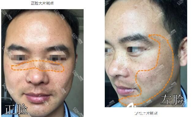 術(shù)前臉上斑點(diǎn)明顯 術(shù)前臉上斑點(diǎn)明顯