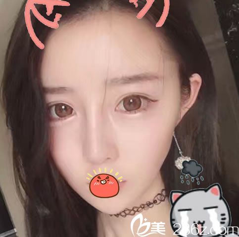 選擇溫州瑞麗做隆鼻10天效果