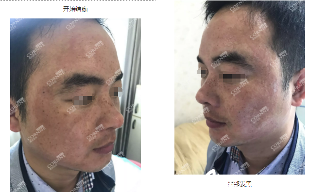 剛做完皮秒祛斑面部慢慢開始結(jié)痂 剛做完皮秒祛斑面部慢慢開始結(jié)痂