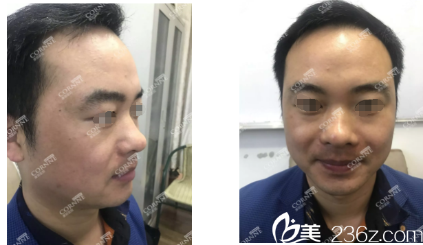 男人臉上長(zhǎng)斑怎么辦?看邋遢大叔到張家港康麗找張麗華主任給做皮秒激光祛斑秒變小哥哥