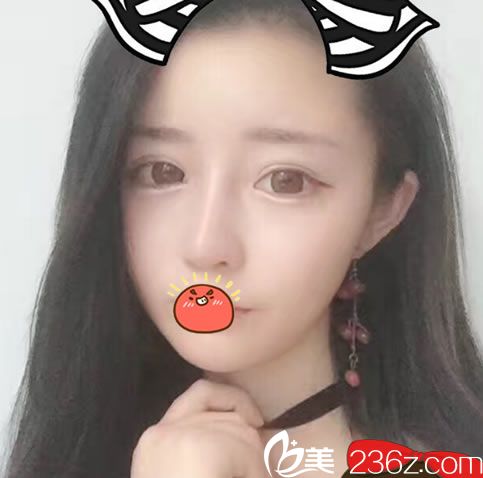 做完隆鼻和脂肪填充50天恢復(fù)照