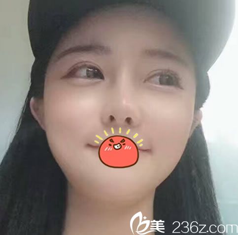 之前找溫州瑞麗整形俞劍鋒做過雙眼皮現(xiàn)在又找他做了隆鼻和面部脂肪填充