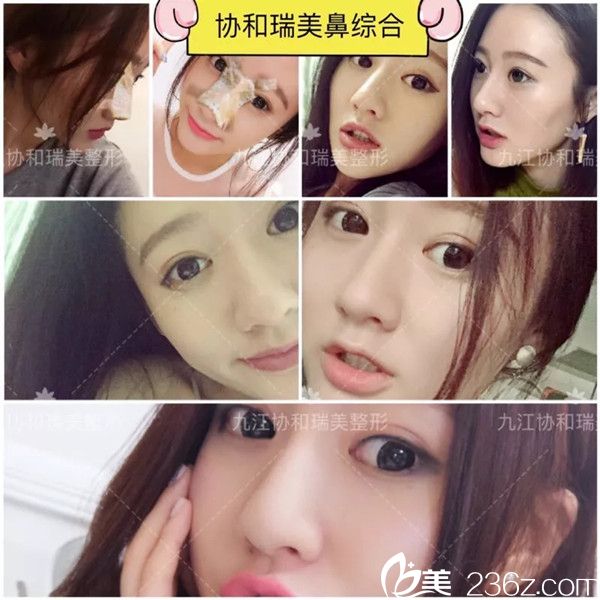 九江星瑞美隆鼻案例