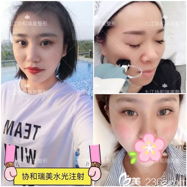 九江星瑞美注射案例