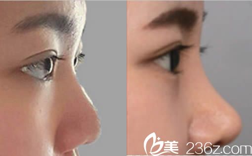 韓國然美之整形醫(yī)院隆鼻案例效果圖
