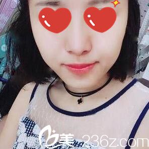 美plus崔尚默做的鼻整形術(shù)后1個(gè)月 美plus崔尚默做的鼻整形術(shù)后1個(gè)月