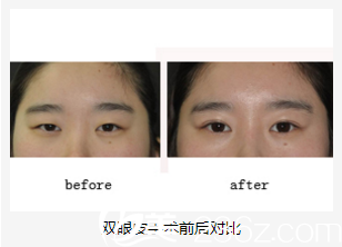 美藝雙眼皮整形前后對(duì)比 美藝雙眼皮整形前后對(duì)比