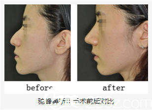 美藝鼻矯正前后對(duì)比 美藝鼻矯正前后對(duì)比